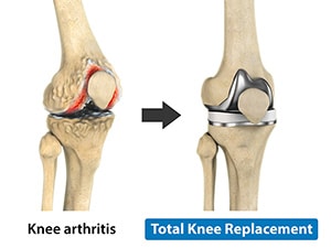 Total-knee-replacement graphic