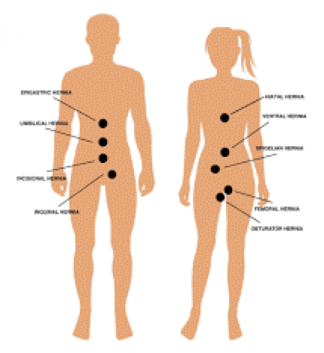 male and female outlines with hernia locations